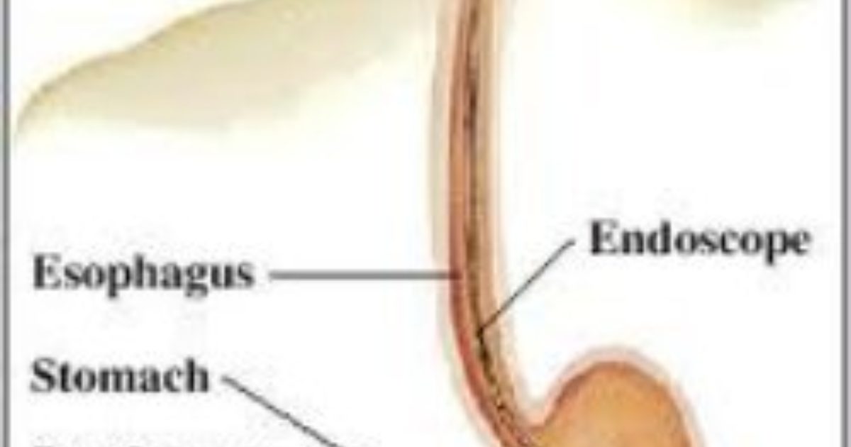 egd-upper-gi-endoscopy-gi-associates