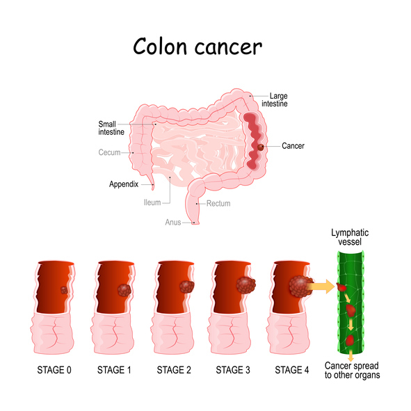African Americans At Higher Risk of Colon Cancer: | GI Associates