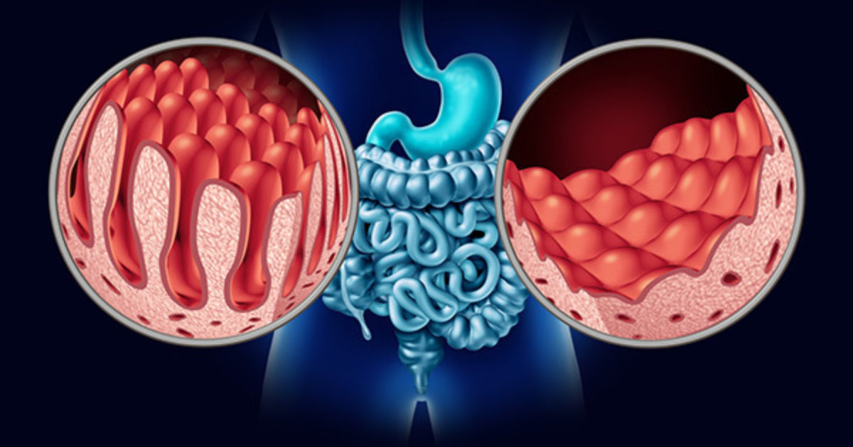 Got A Celiac Disease Diagnosis? What's Next? | GI Associates