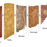 Fatty Liver