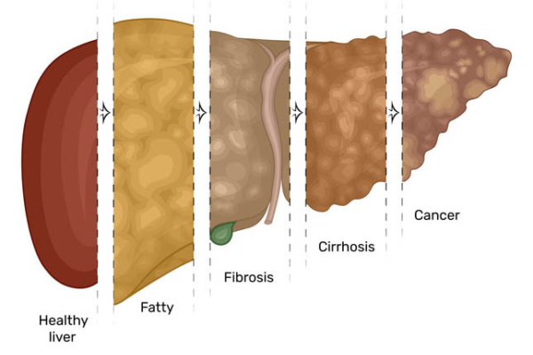 Fatty Liver