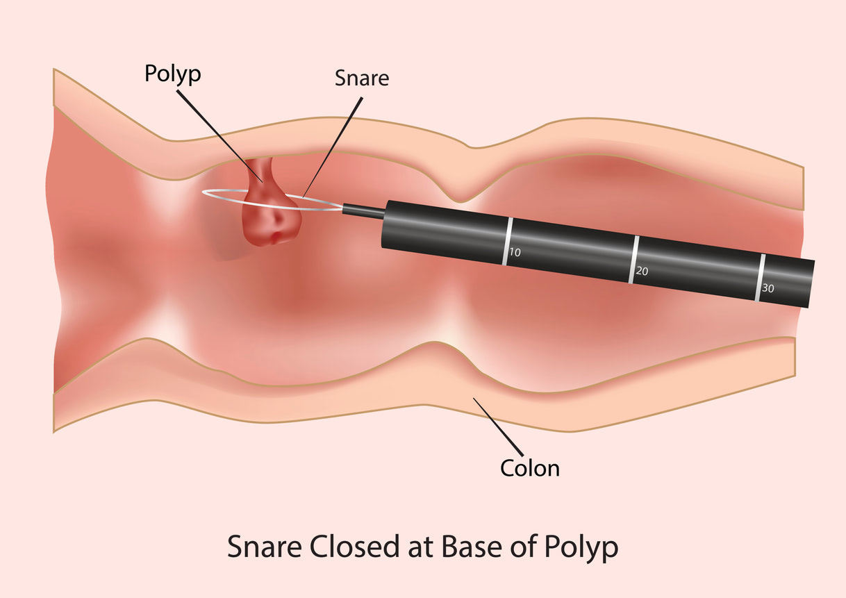 Colonoscopy removes polyps