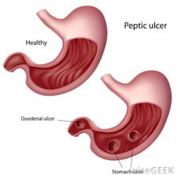 Diagram of peptic ulcer